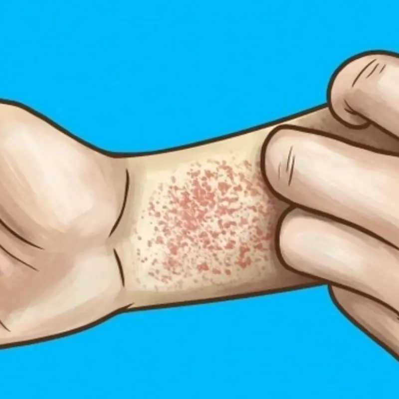 5 Warning Signs of Severe Lu.pus
