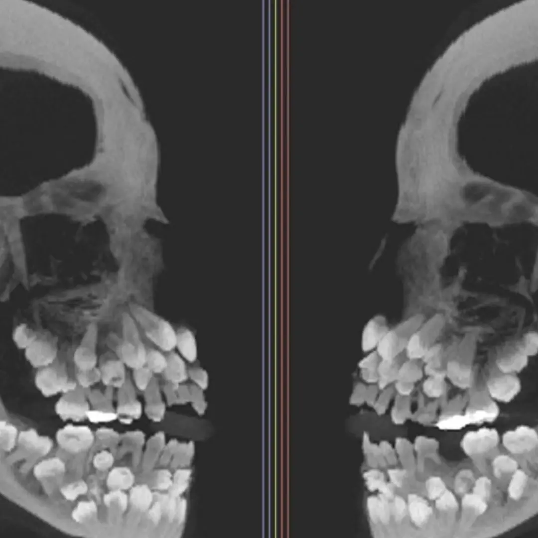 A girl in Brazil was found to have 81 teeth in her mouth
