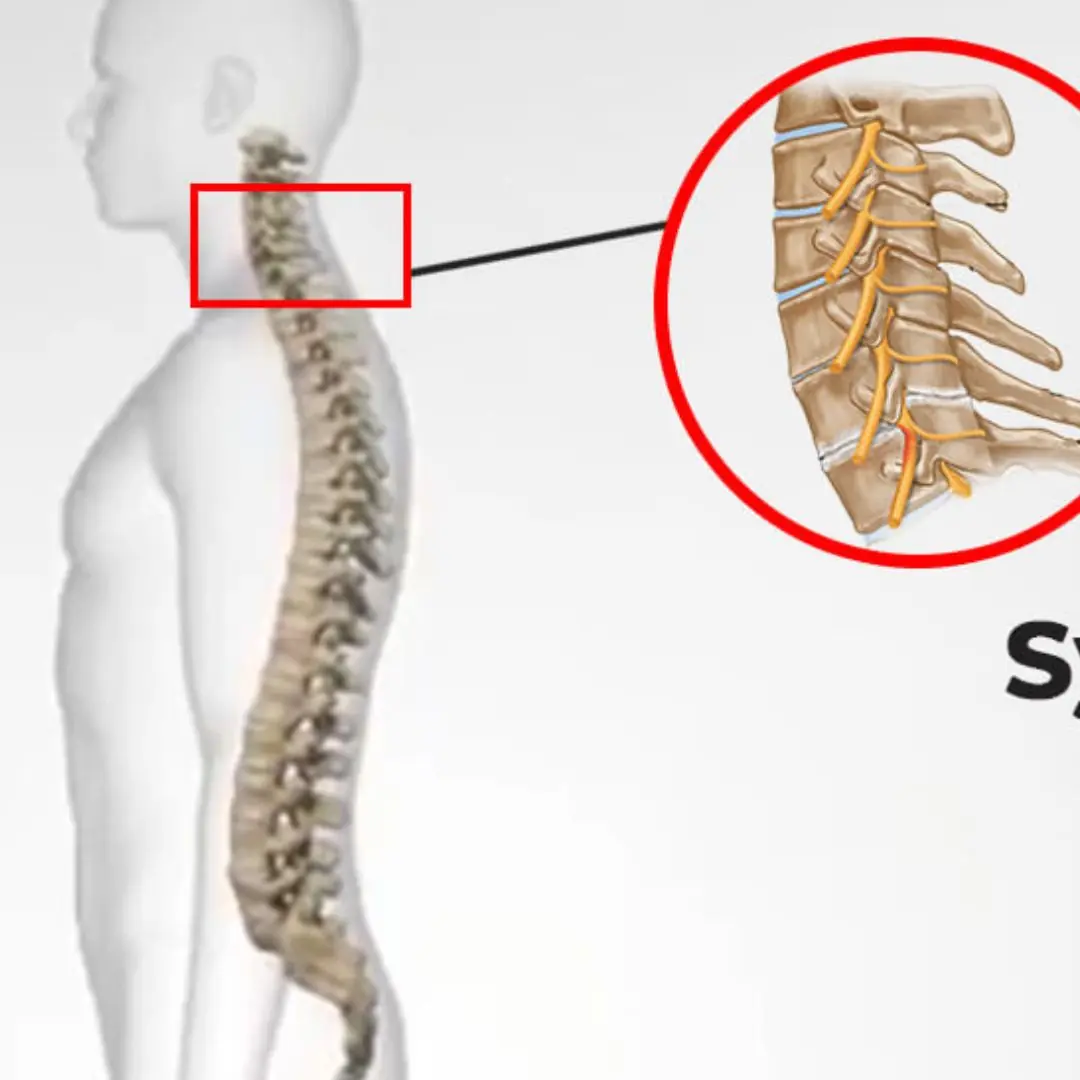 Cervical Spondylosis — A Common Cause of Neck P.a.in