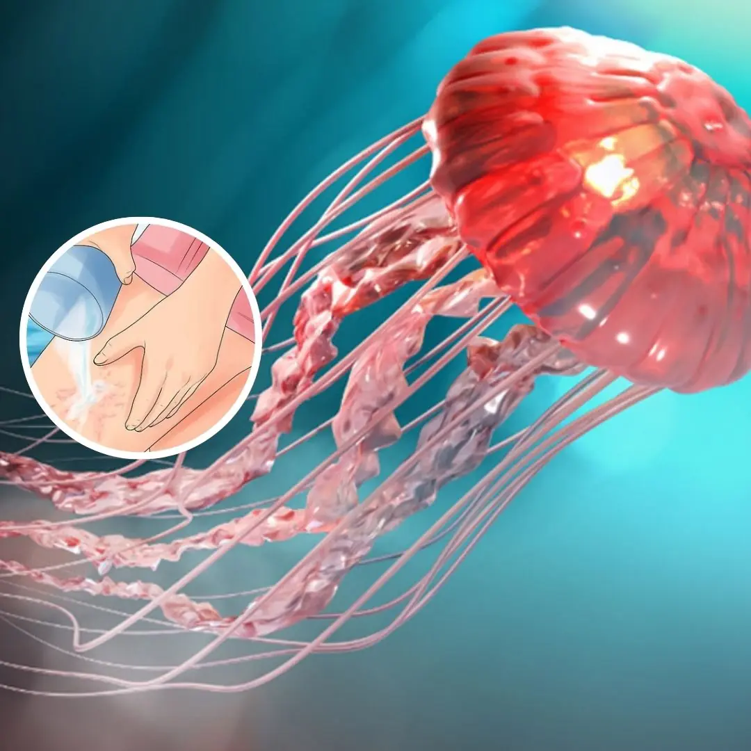 First Aid for Jellyfish Stings: What Science Says You Should (and Shouldn’t) Do