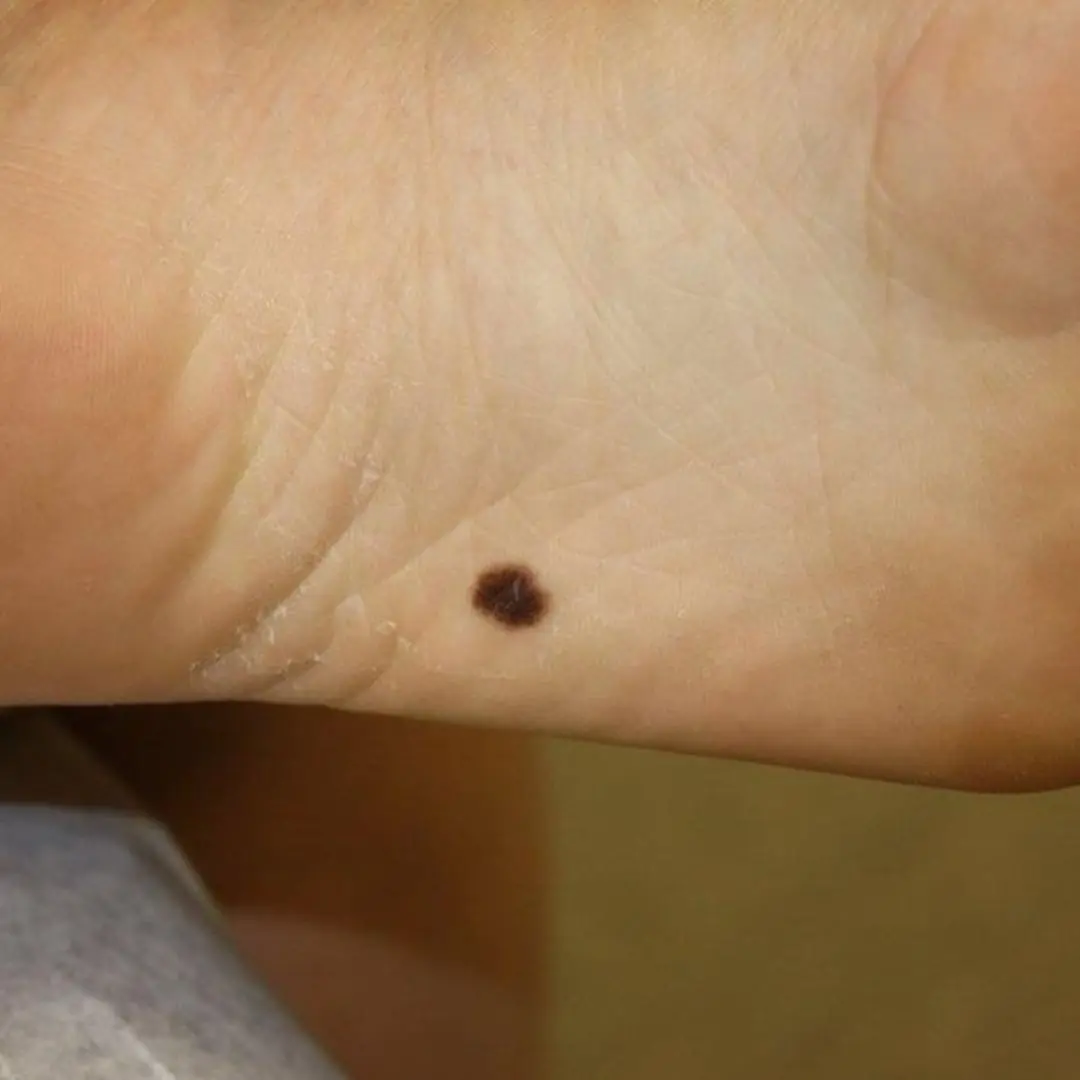 There was a mole on my leg that I thought was normal, but it kept getting bigger and bigger, but it turned out to be cancerous.