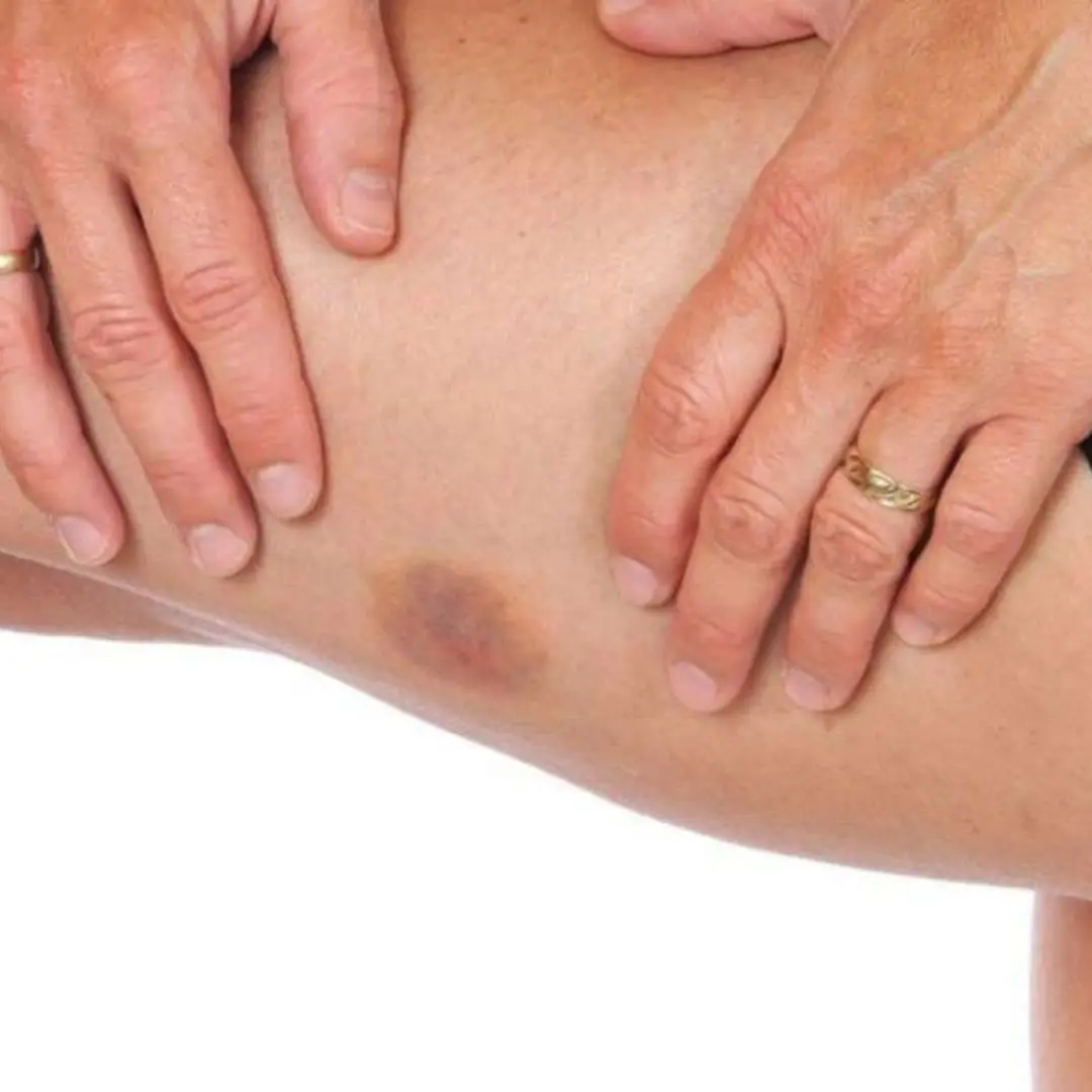 Unexplained Bruising on Your Body: Causes and Treatments
