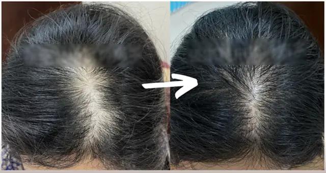 To Prevent Hair Loss and Stimulate Hair Growth, Avoid These Habits