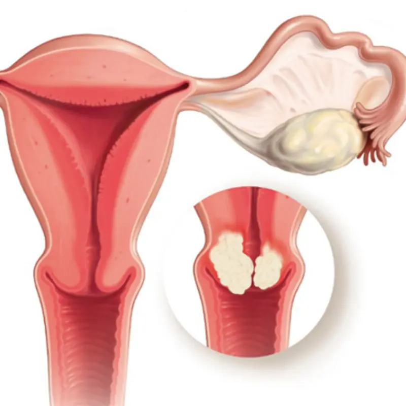 Women Who Frequently Eat These 5 Foods May Be Harming Their Uterus and Feeding Cancer Cells Without Knowing It