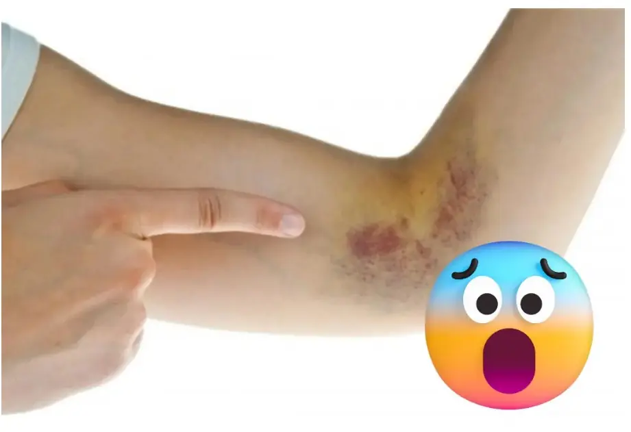 Simple signs to immediately recognize leukemia that you may never notice