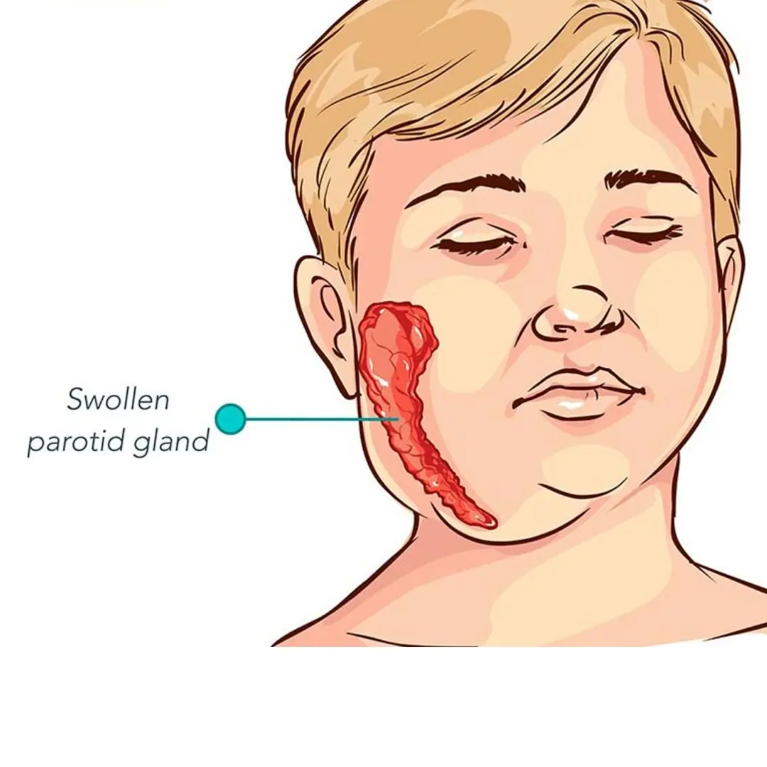 Does mumps in men affect reproductive health?