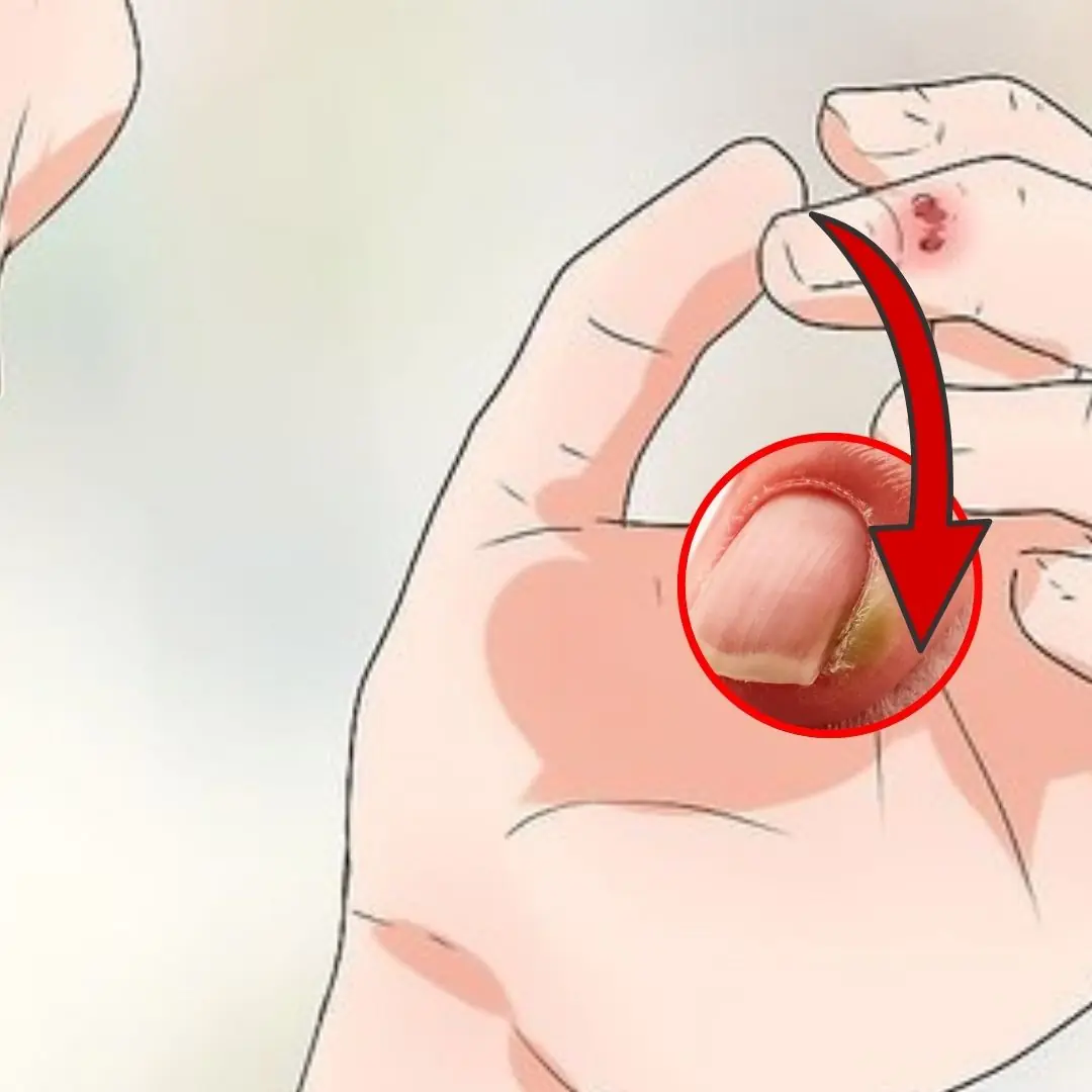 Suffering from Canker Sores? Here Are 3 Powerful Home Treatments You Should Try