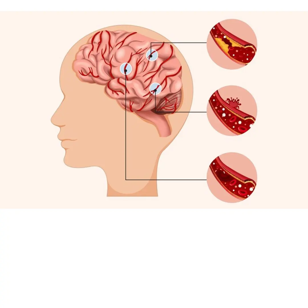 Why Can Young People Still Suffer Strokes and Sudden Death? 5 Dangerous Habits You Need to Quit Immediately