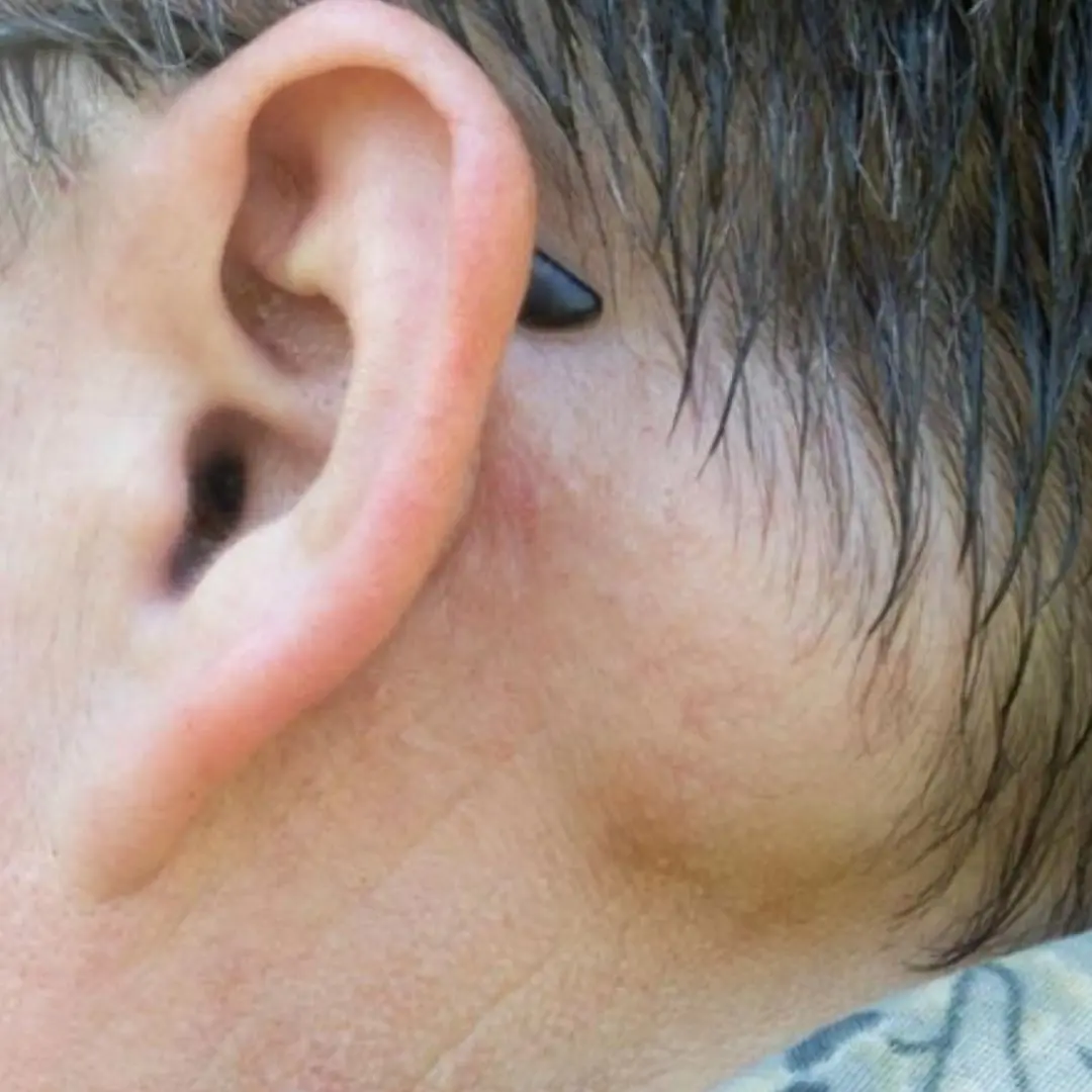 Is painless swollen lymph nodes behind the ear da.nge.rous?