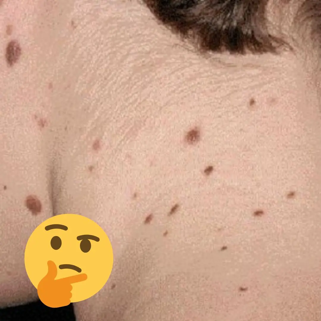 Unusual moles might be more than just a skin quirk — they could be warning signs of cancer