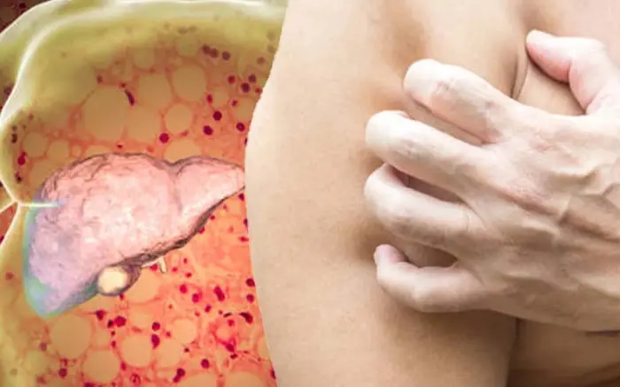 5 Skin Signs Warning of Early Liv.er Damage