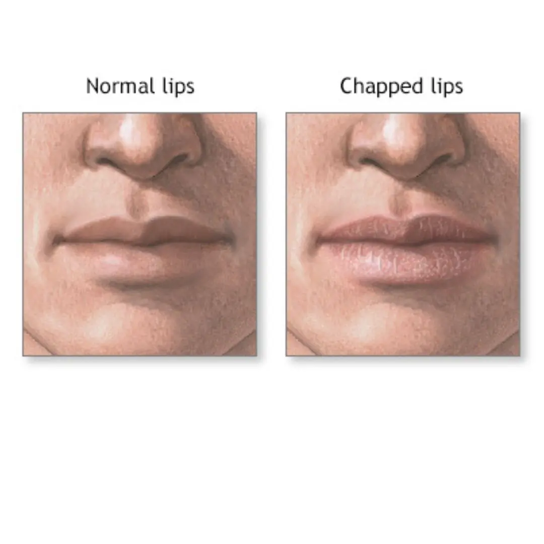 The 8 warning signs your lips reveal about your health – from herpes to liver disease