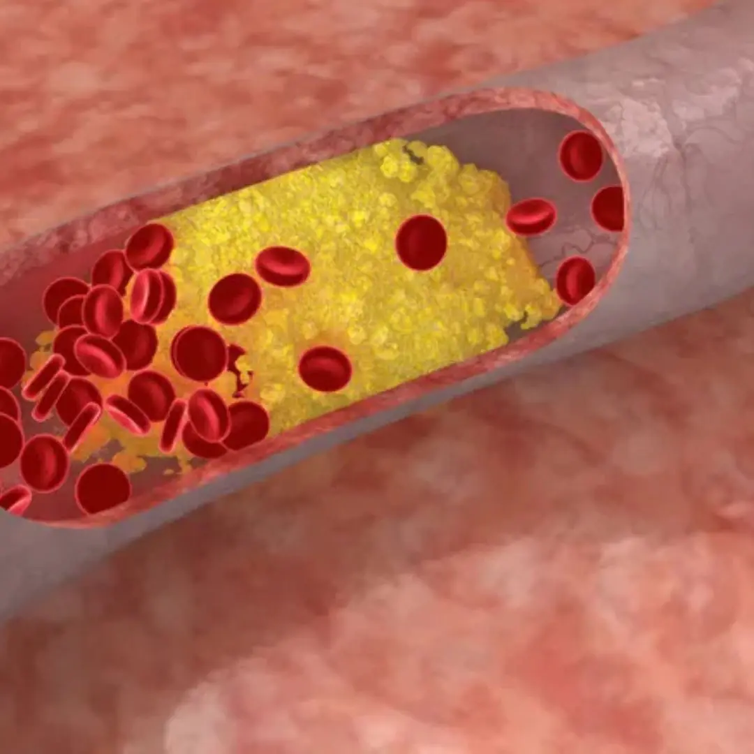 6 hidden dangers of fatty blood disease doctors warn about