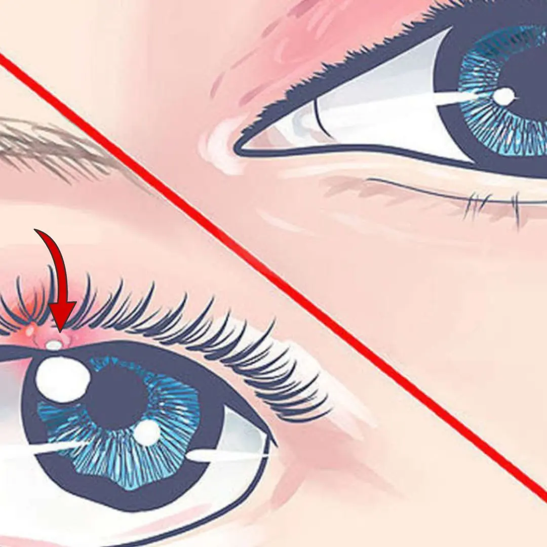 What Exactly Is a Stye — and How Can You Get Rid of It?