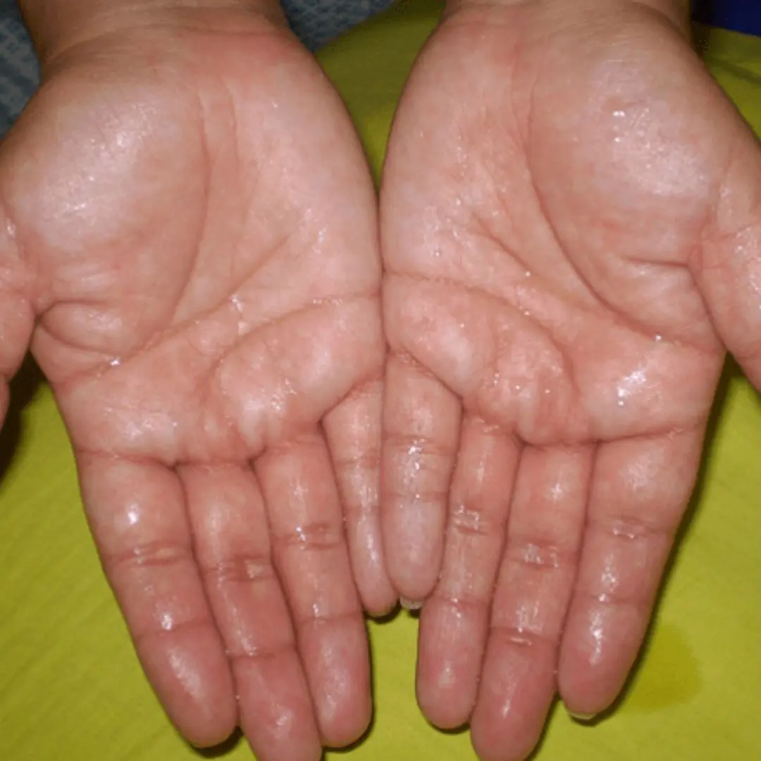 What’s Really Going On When Your Hands and Feet Won’t Stop Sweating?
