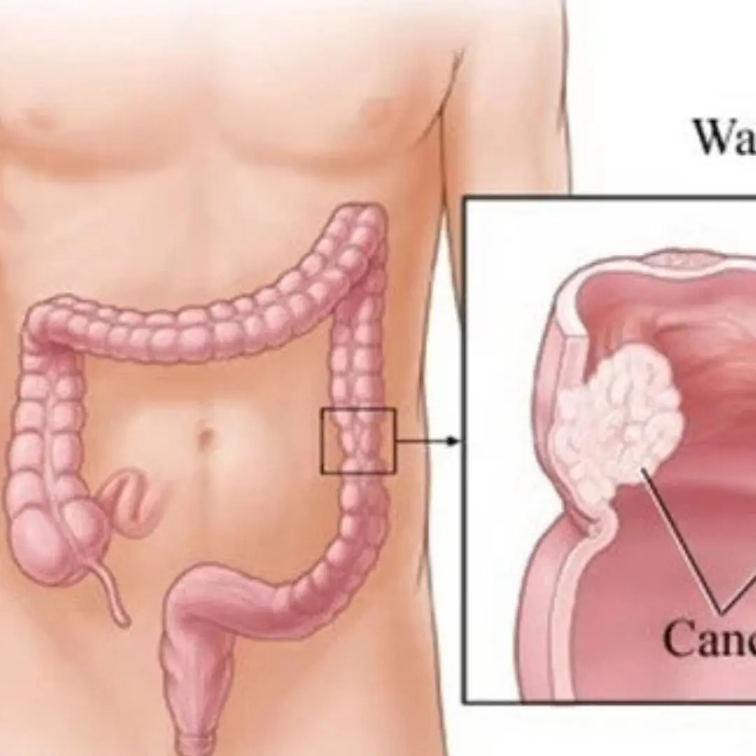 Ca.n.cer is painless at first, but if you notice these 8 signs while going to the bathroom, you should see a doctor immediately