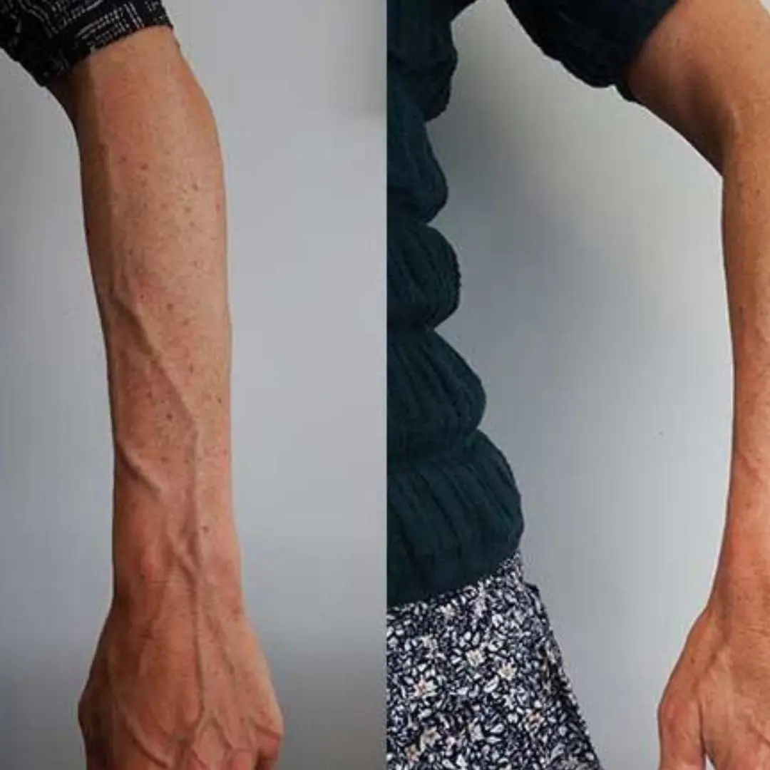 Bulging Arm and Hand Veins: Causes and Treatments