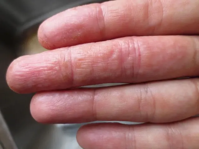 4 Finger Signs That May Signal Li.ver and Lu.ng Can.cer