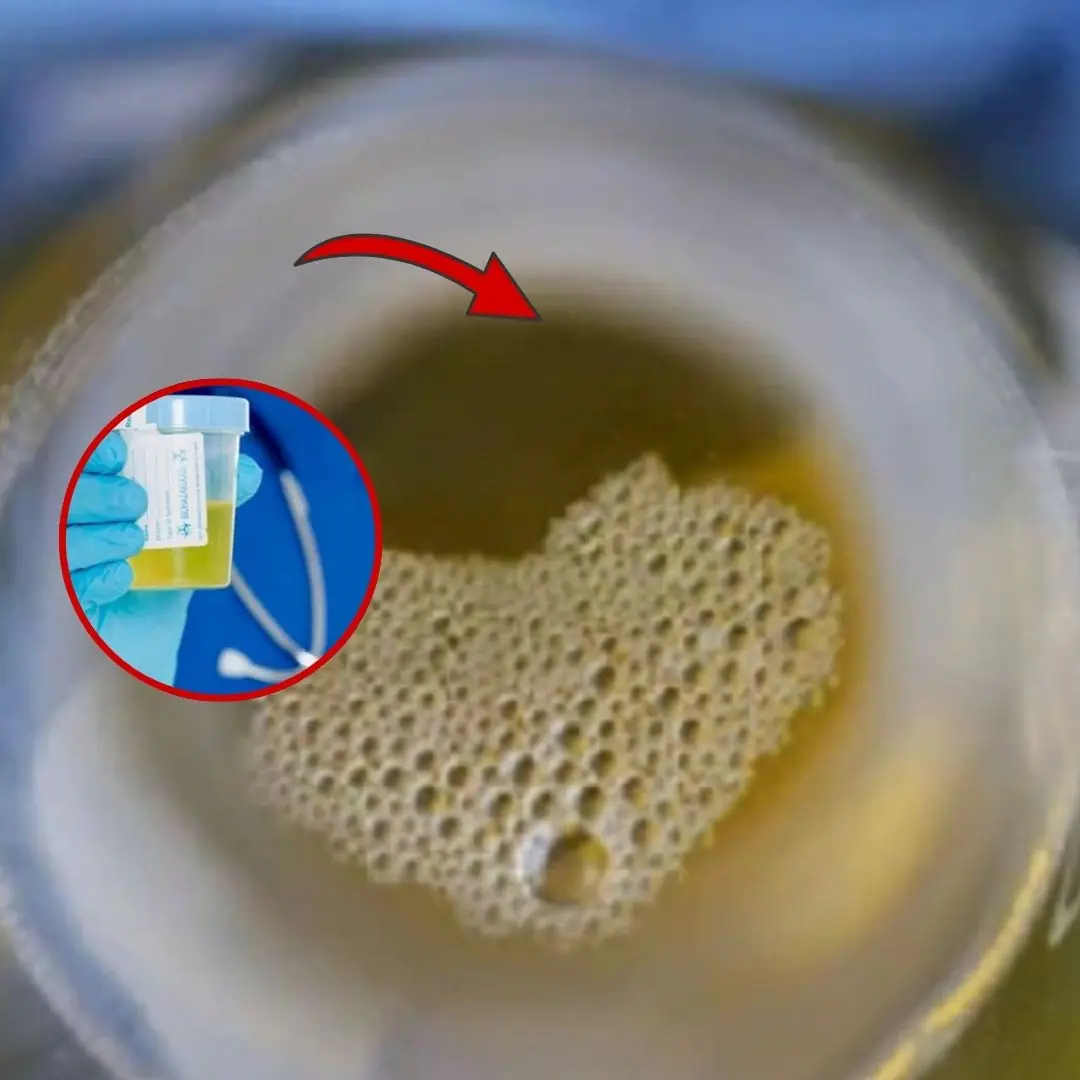 Men and women who see these 3 signs in their urine need to see a doctor for kidney failure immediately