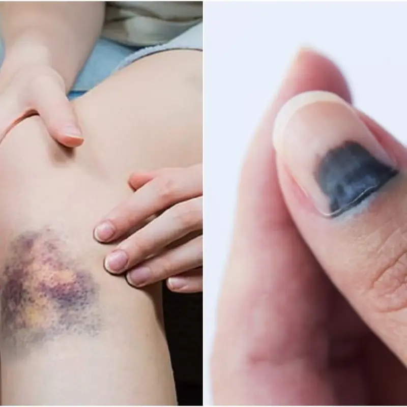 5 Areas of the Body Turning Black May Indicate Can.cer