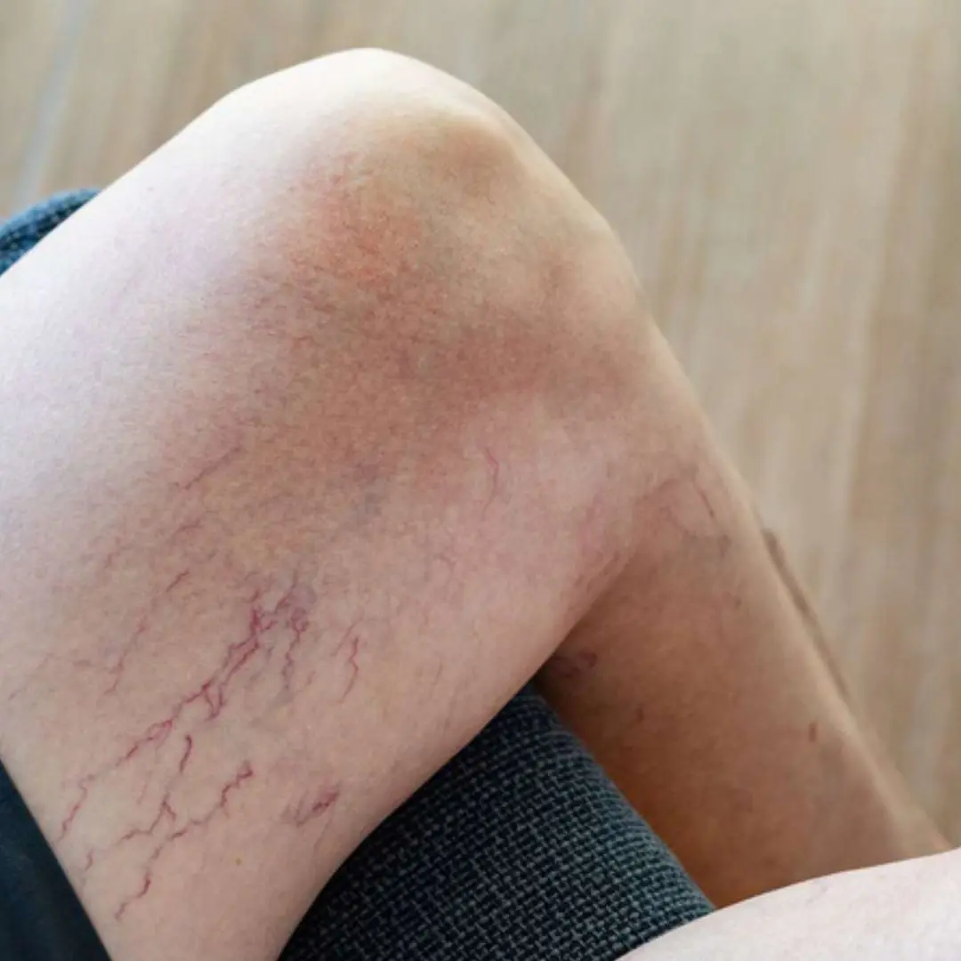 Leg Veins Turning Purple? Here’s What You Need to Know