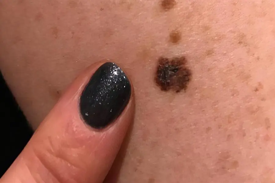 4 Types of Pimples That Could Be a “Disguise” for Can.cer