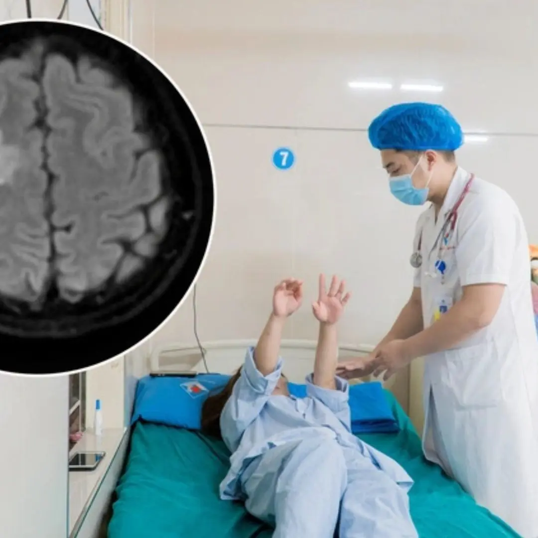 Headache for 5 days, woman suddenly fell to the ground, co.nvulsed, had difficulty speaking