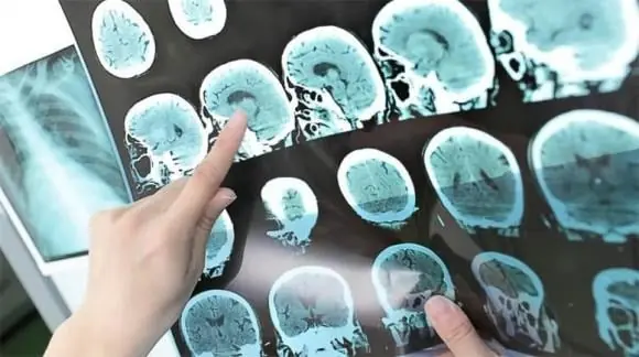 6 Golden Habits to Help Seniors Reduce the Risk of Cerebral Infarction