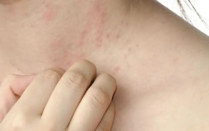 Woman Shocked by Doctor’s Diagnosis After Visiting Hospital for Severe Itching