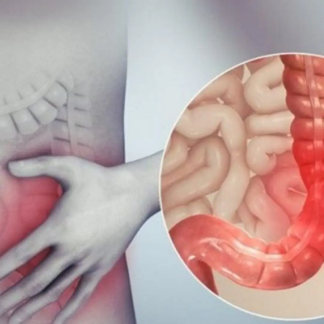 Don’t Overlook These 6 Warning Signs of Stage 1 Colon Cancer