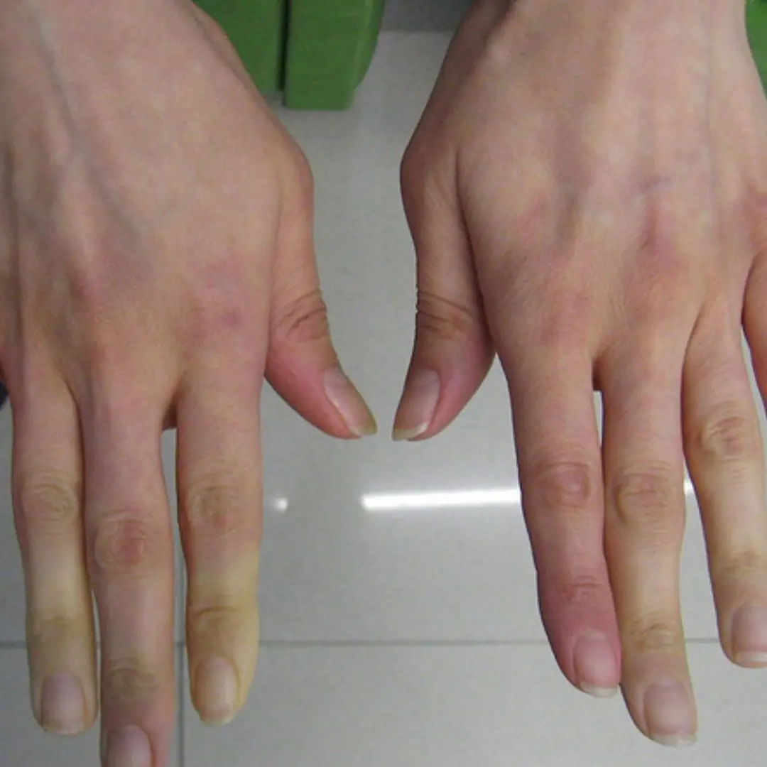 This condition can trigger a sudden transformation in the fingers, leaving them ghostly white or bluish