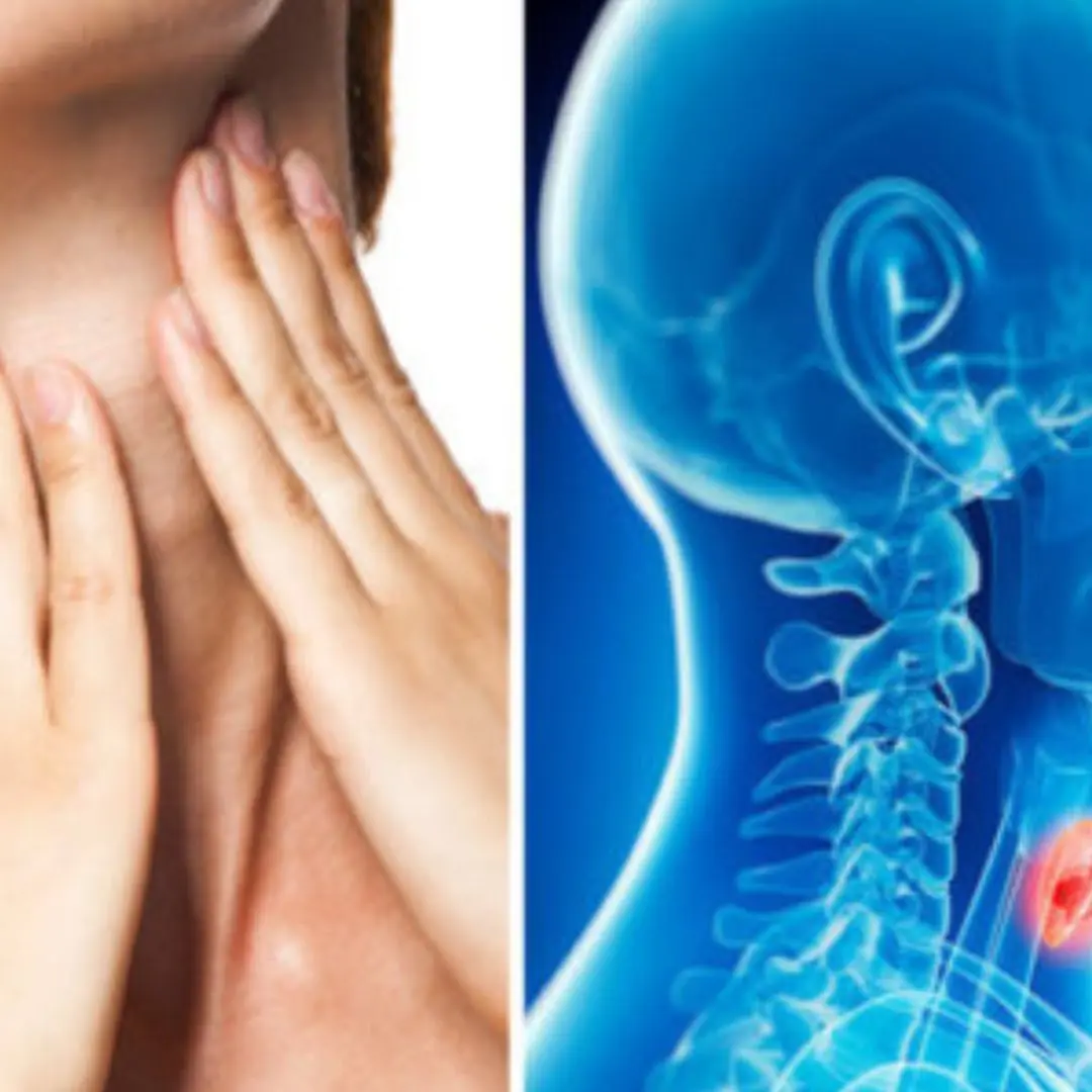 Catching Nasopharyngeal Cancer in Its Early Stages May Offer a 72% Survival Rate