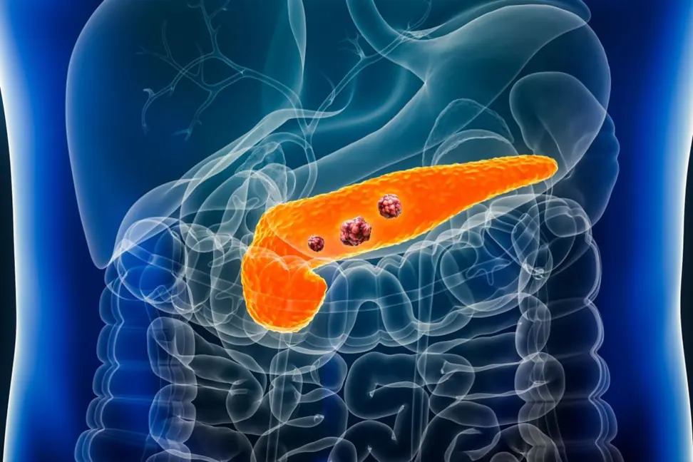 The Habit That Puts Millions at Risk of Pancreatic Can.cer