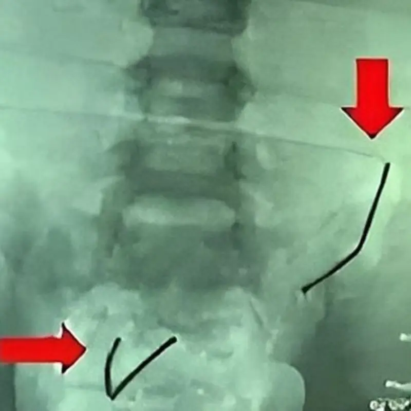 5-Year-Old Boy’s Sto.mach Pain Leads to Shocking Discovery