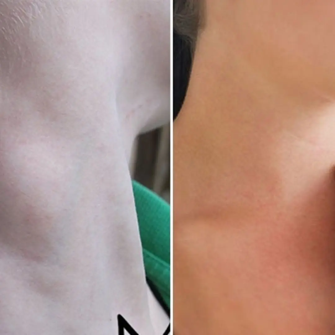 Signs and treatment of early stage nasopharyngeal cancer