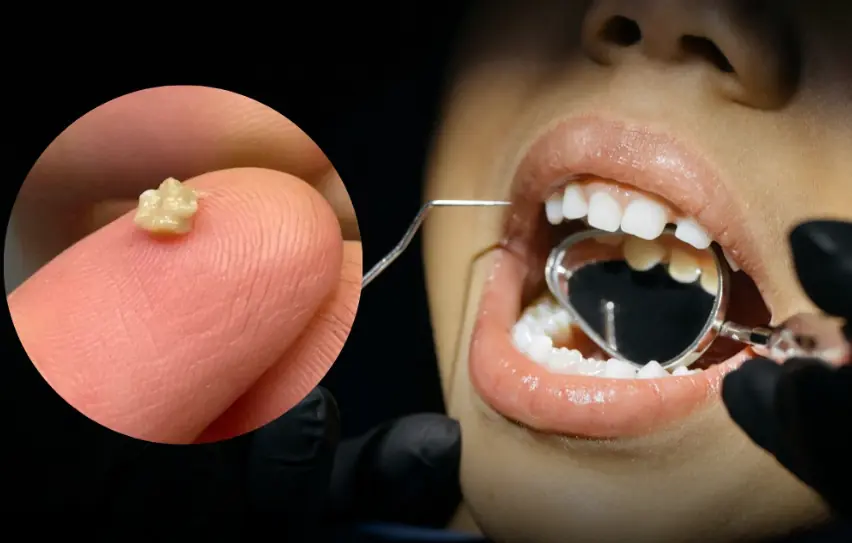 7-year-old boy mo.cked by classmates for bad smell, mother stunned by what doctor removed from his mouth