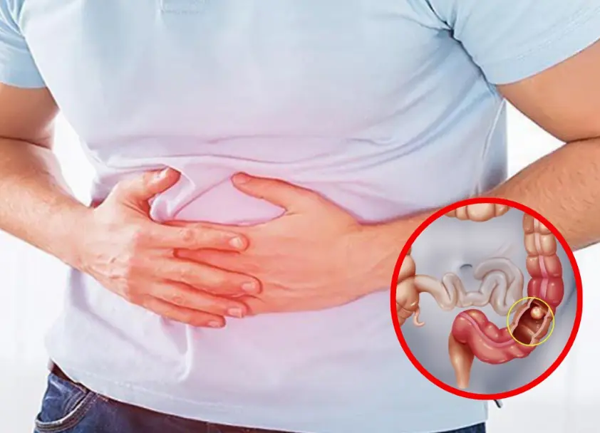 6 early warning signs of stage 1 colon can.cer you shouldn’t ignore