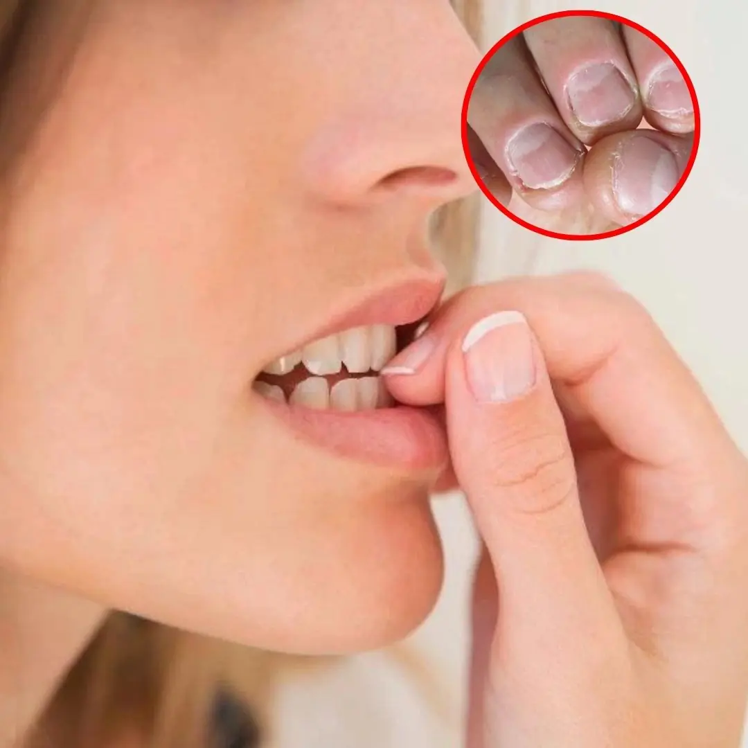 Don’t take nail-biting lightly — it may be linked to these dangerous conditions