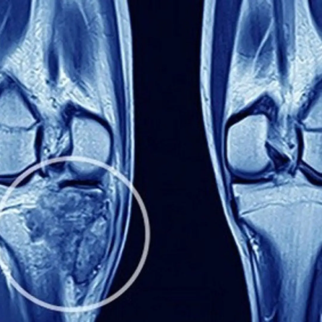 5 Dangerous Signs Warning of Bone Cancer – Recognize It Early!