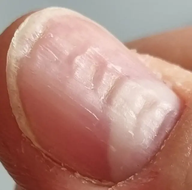 7 Nail Abnormalities That May Reveal Hidden Tumors in the Body