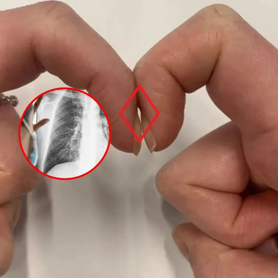 5 - Second Test to Assess Lung C.a.ncer Risk