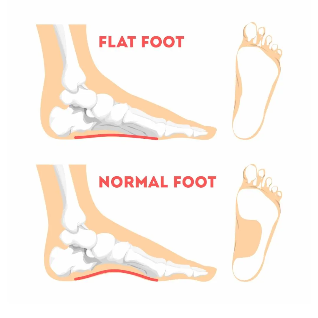 Flat feet in ch.il.dren — should parents be worried?