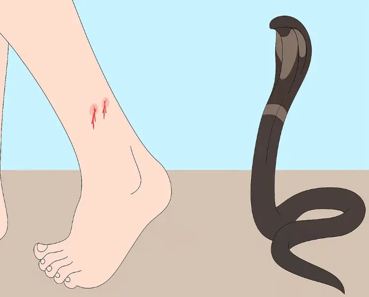 What to do immediately after a snake bi.te