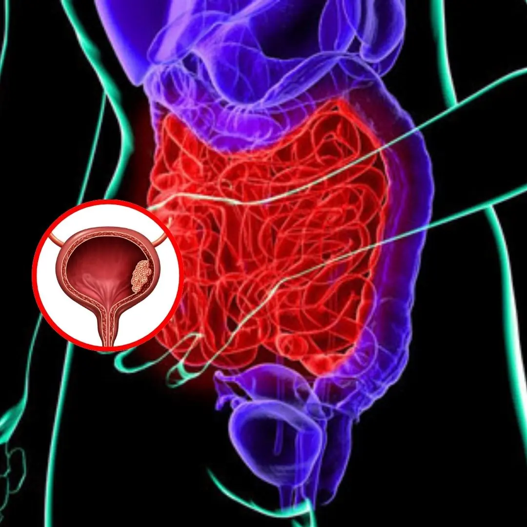 Bladder C.a.ncer: 5 Subtle Early Symptoms to Watch Out For
