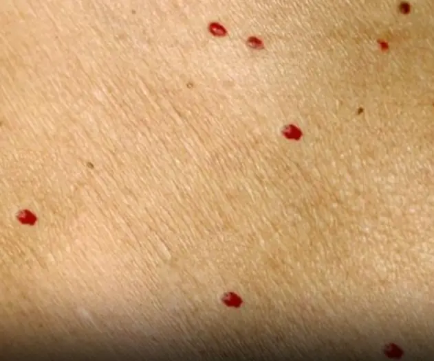 Red Dots On Your Skin Causes And What They Could Mean