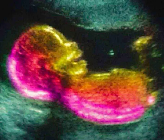 Study identifies possible connection to autism development