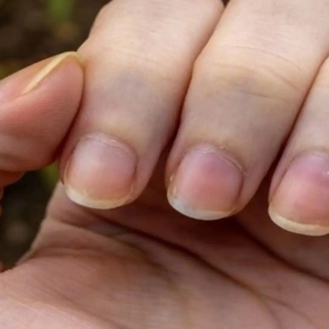 Little-noticed signs on your fingernails can warn you of ca.ncer