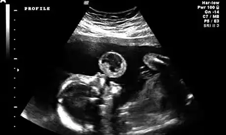 Mother’s Ultrasound Shows Baby ‘Blowing Bubbles’
