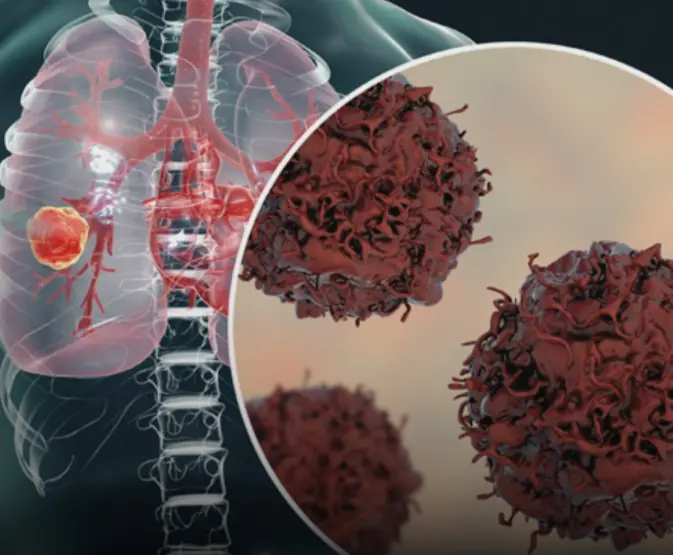 The "hidden nature" of early stage lung can.cer