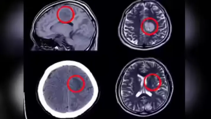 12 signs that may signal a brain aneurysm — Don’t ignore them